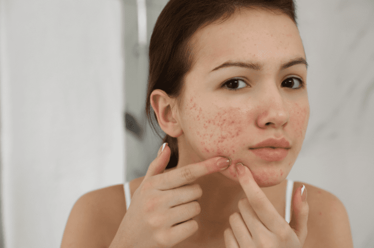 Pimples, Acne revampearth.com