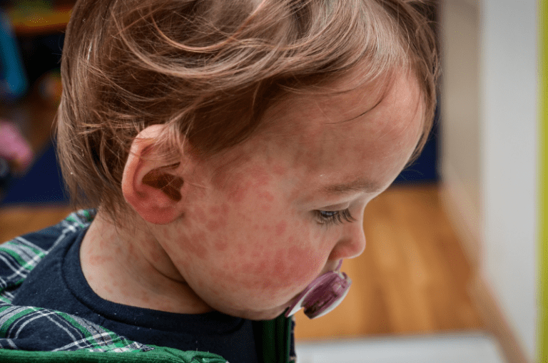 Skin Disorders in Children