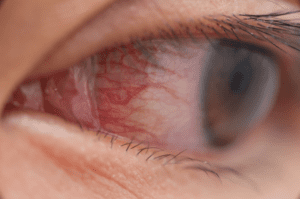 eye infections