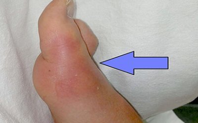 Gout: A common and complex form of arthritis.
